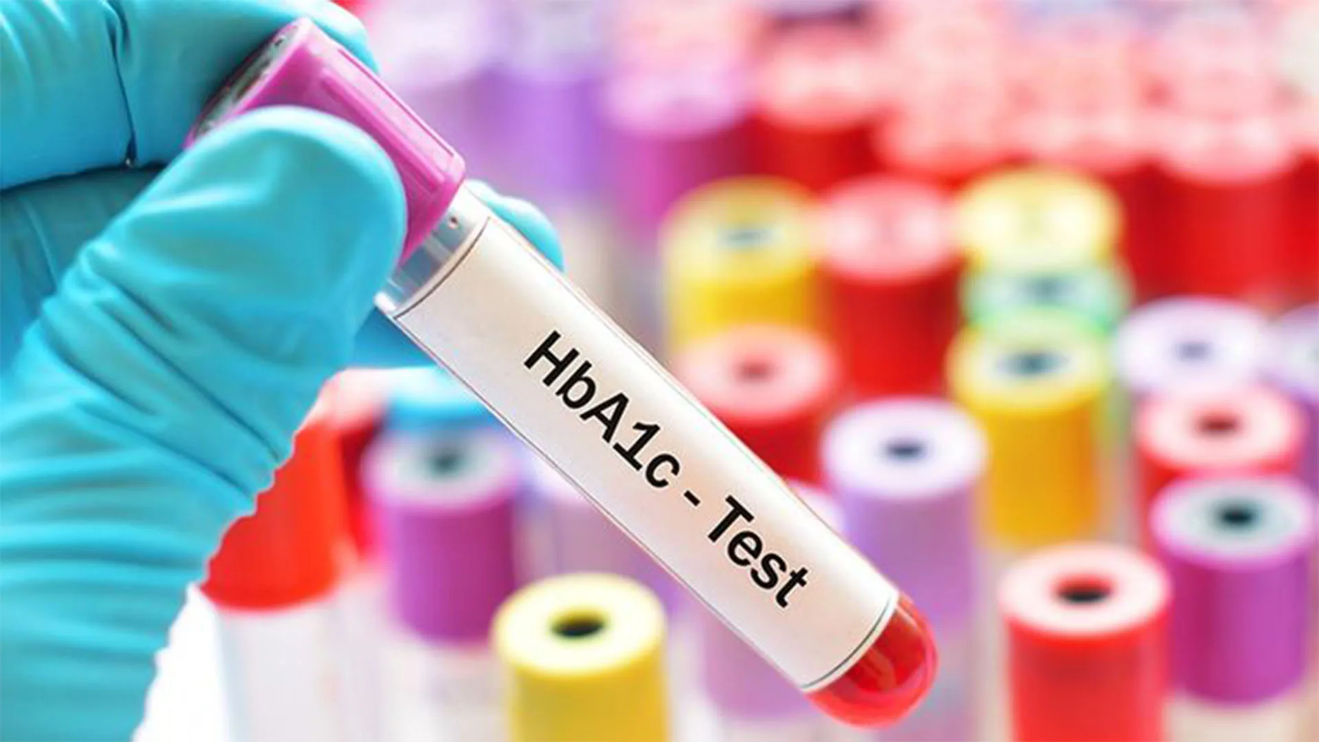 تحليل السكر التراكمي (HbA1c) في إسطنبول