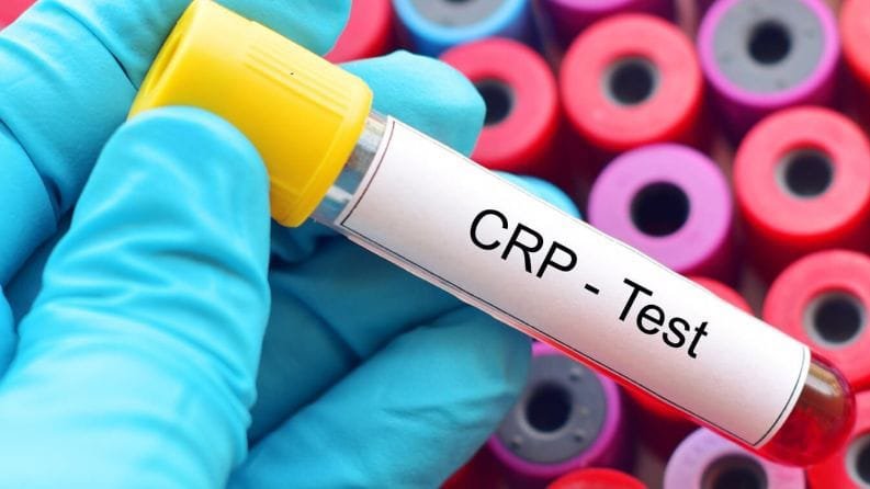 تحليل CRP في الدم داخل مخبر تحاليل طبية في إسطنبول للكشف عن الالتهابات الحادة والمزمنة.