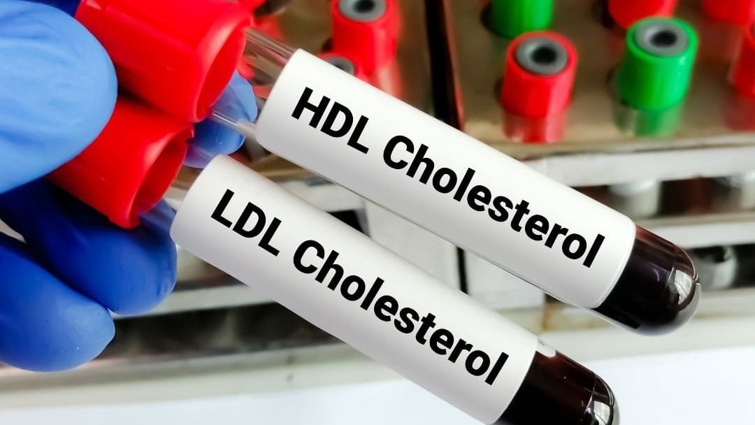 تحليل الكوليسترول النافع HDL في الدم داخل مخبر تحاليل طبية في إسطنبول لتقييم صحة القلب.