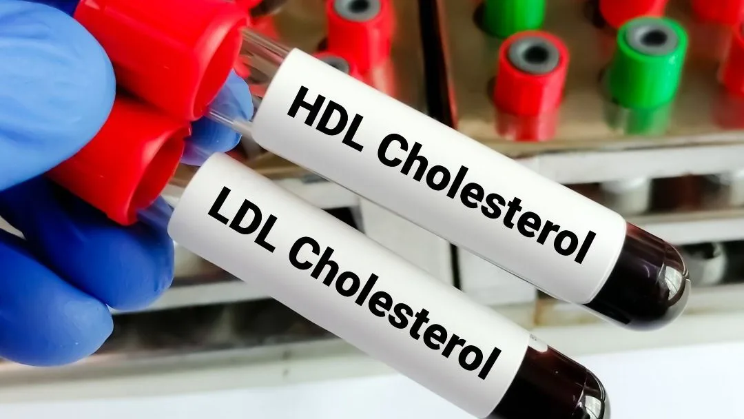تحليل الكوليسترول الضار LDL – مخبر تحاليل طبية إسطنبول