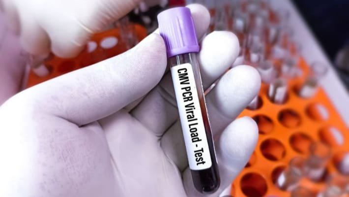 تحليل CMV IgG وIgM في إسطنبول للكشف عن الإصابة الحالية أو السابقة بالفيروس المضخم للخلايا.
