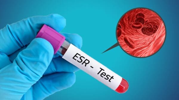 تحليل سرعة الترسب ESR في إسطنبول للكشف عن الالتهابات والأمراض الروماتيزمية والمناعية.