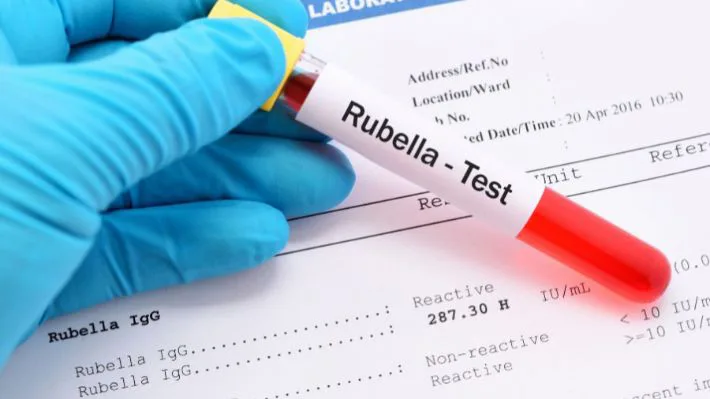تحليل الحصبة الألمانية Rubella IgG وIgM في إسطنبول للكشف عن المناعة أو العدوى الحديثة بفيروس الحصبة الألمانية.